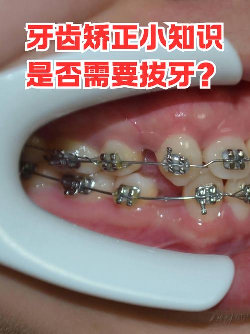 孩子正畸需要拔牙吗-图3