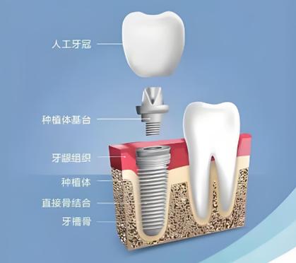 植牙成功的标准究竟包含哪些关键衡量指标？-图1