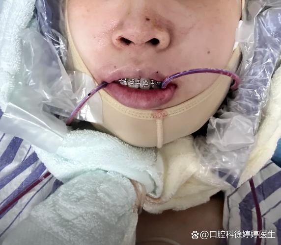 下颌偏斜正畸非手术-图1