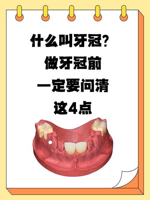 植完牙体后一般需要多久才能戴上牙冠?-图2 植完牙体后一般需要多久才能戴上牙冠?-图2