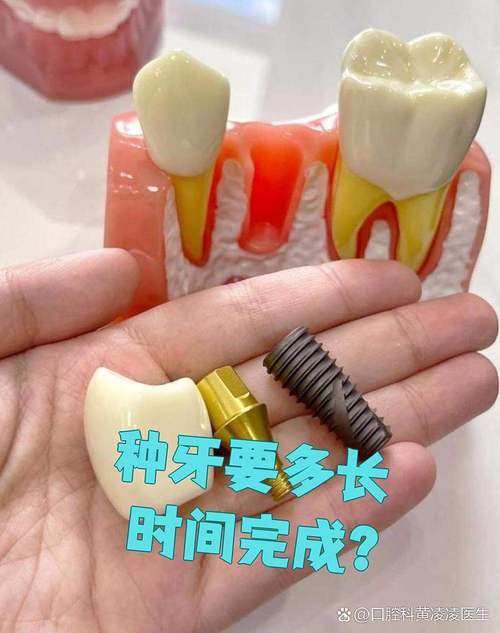 植完牙体后一般需要多久才能戴上牙冠?-图1 植完牙体后一般需要多久才能戴上牙冠?-图1