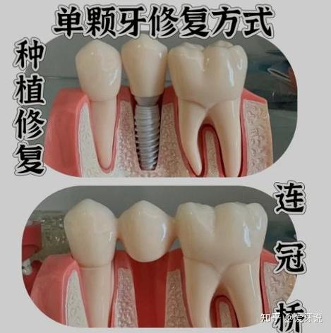 镶牙和植牙美冠塔专业-图1 镶牙和植牙美冠塔专业-图1