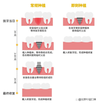 导板植牙是否即种即食-图1