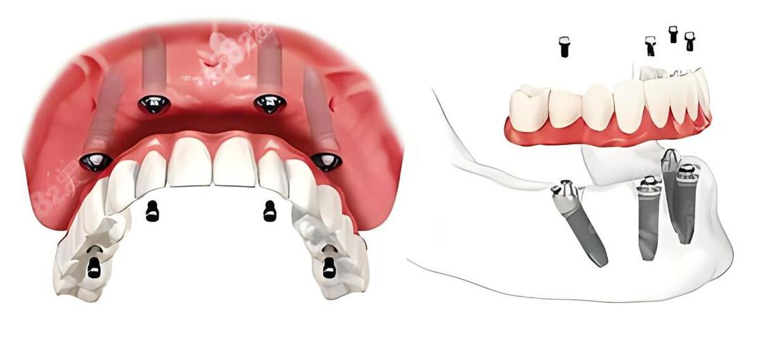 导板植牙是否即种即食-图2