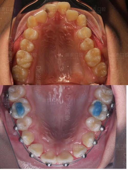 长沙哪里正畸效果好-图1
