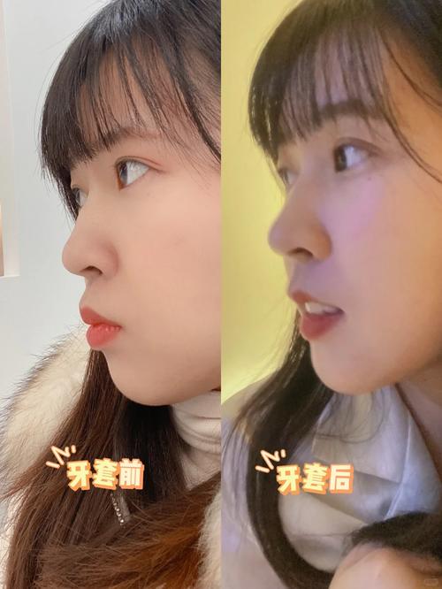 长沙哪里正畸效果好-图2