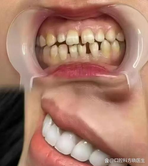 正畸牙缝不能关闭了-图3
