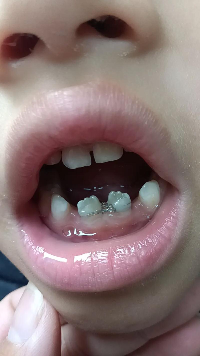 正畸牙缝不能关闭了-图2