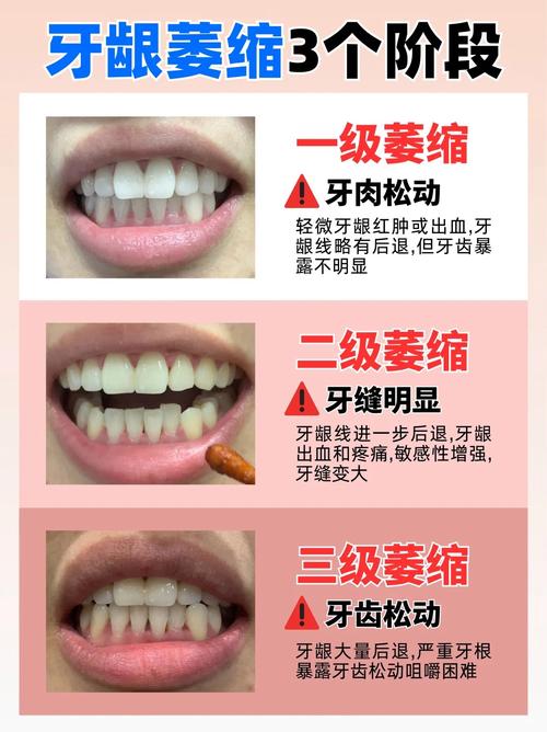 植牙后几天牙龈萎缩了-图1