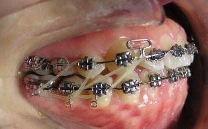正畸挂皮筋多久手术-图1