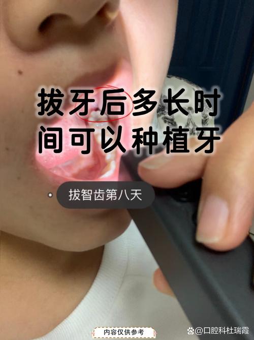 种牙植体伤口愈合需多久？术后恢复周期多长？-图3