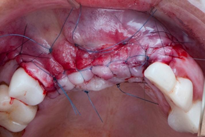 种牙植体伤口愈合需多久？术后恢复周期多长？-图2