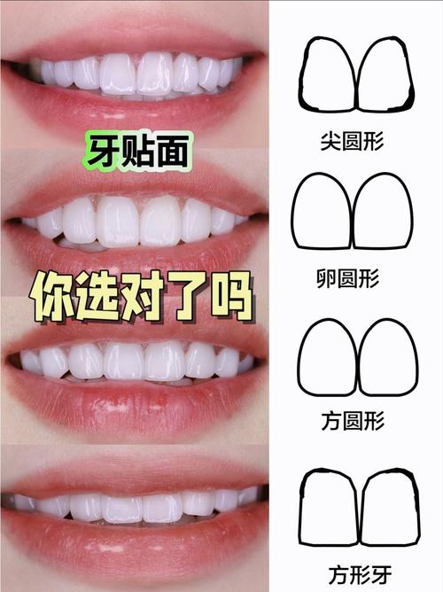 牙齿正畸vs贴面，到底该怎么选？-图3