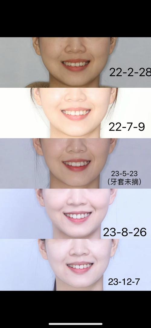 无托槽隐形正畸视频能真实展示矫正效果与过程吗？-图2