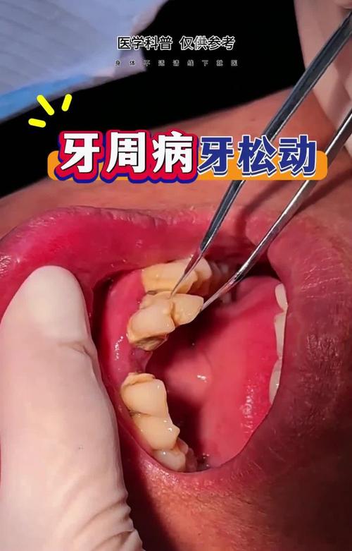 正畸后牙齿松动伴随发炎，是正常反应还是异常情况？-图1