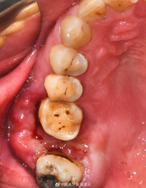 正畸后牙齿松动伴随发炎，是正常反应还是异常情况？-图2