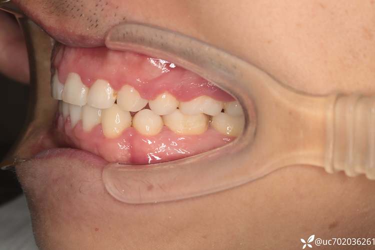 口腔正畸下颌骨紊乱-图1