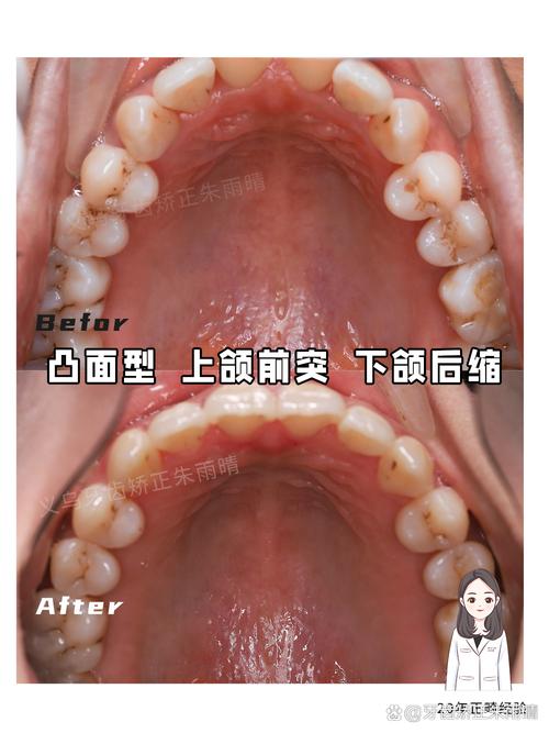 口腔正畸下颌骨紊乱-图3