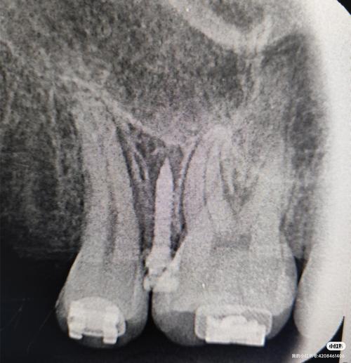 正畸支抗钉植入视频-图2