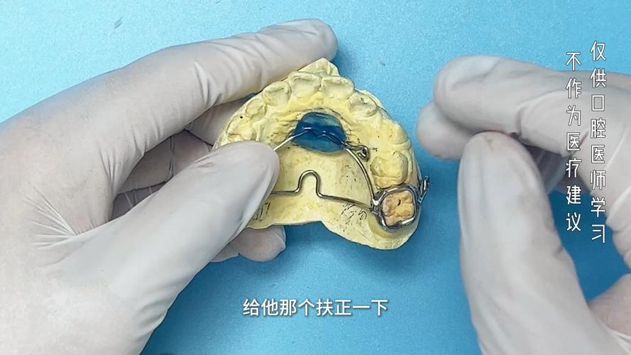正畸横腭杆制作步骤-图3