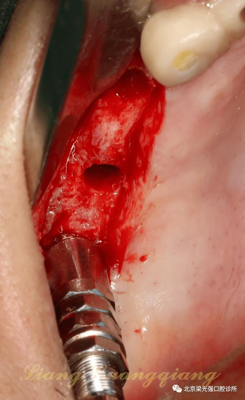 上颌窦囊肿手术后植牙-图1