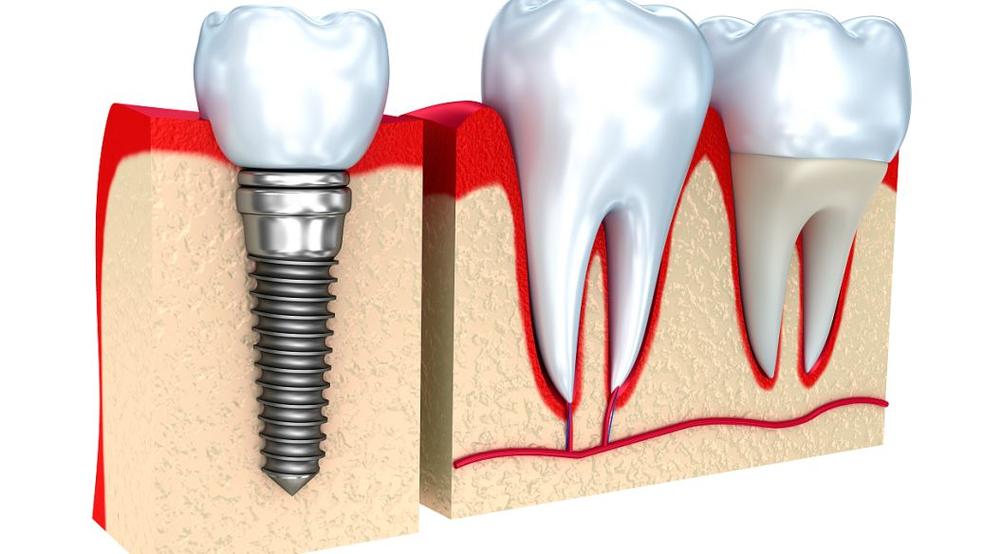 种牙植骨人工骨粉来自-图3 种牙植骨人工骨粉来自-图3