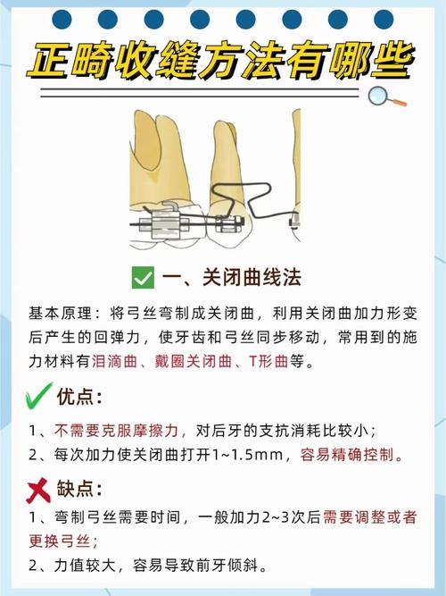 正畸牙怎么关闭缝隙-图1 正畸牙怎么关闭缝隙-图1
