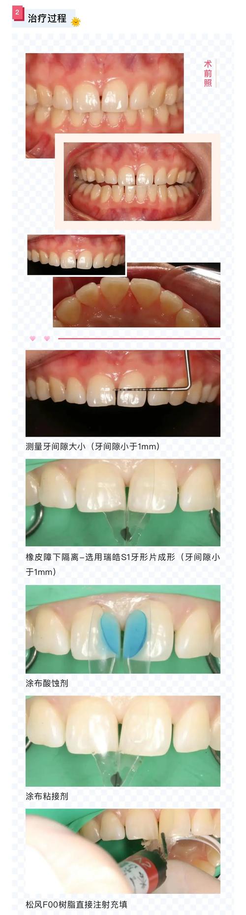 正畸牙怎么关闭缝隙-图3 正畸牙怎么关闭缝隙-图3