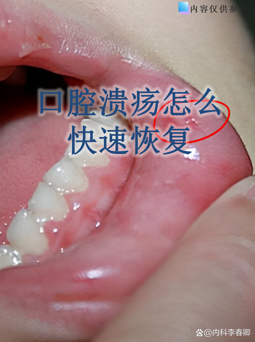 口腔有溃疡可以植牙吗-图1