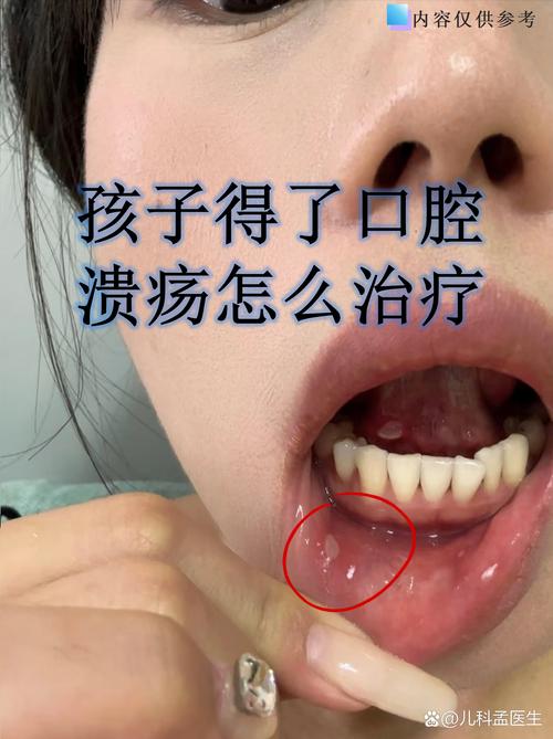 口腔有溃疡可以植牙吗-图3