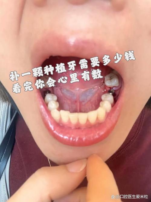 老人补牙好还是植牙好-图3