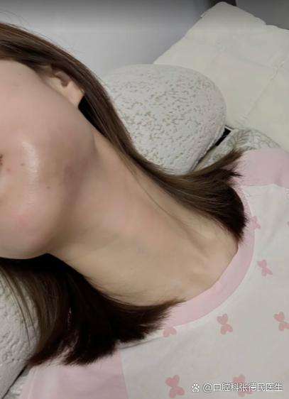 植牙后多久脸才会消肿-图2