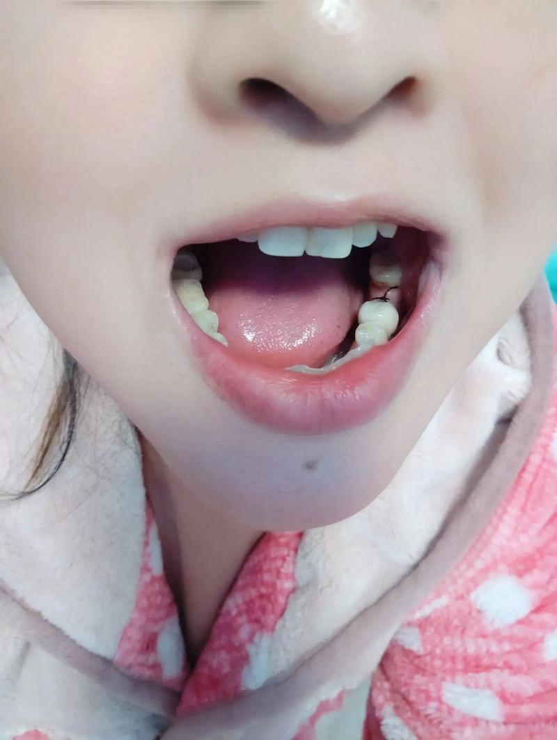 植牙后多久脸才会消肿-图3