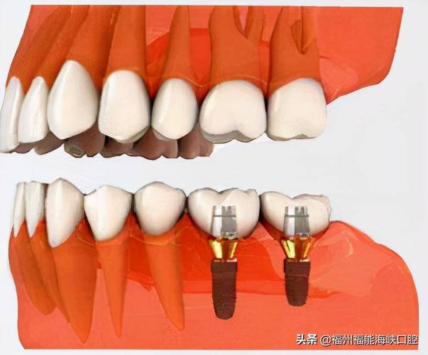 种植牙需要植体露出吗-图3