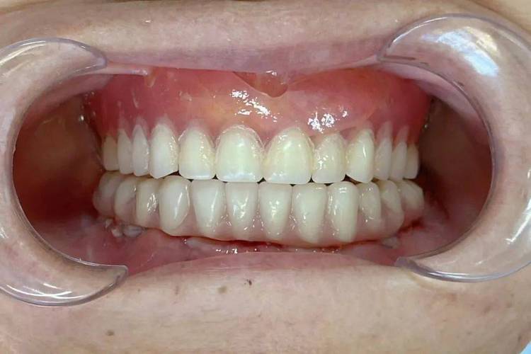 种植牙需要植体露出吗-图2