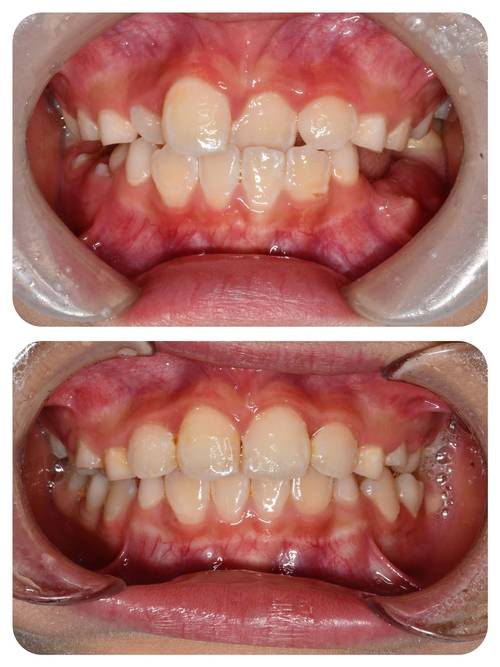 美国孩子牙齿正畸，是普遍现象还是少数选择？-图3