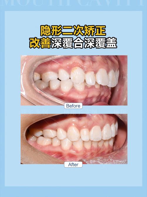隐形正畸解决深覆盖-图1