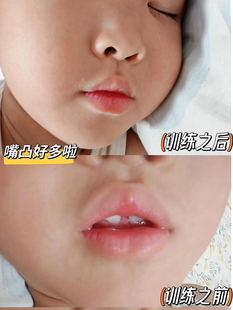 儿童正畸口唇肌训练-图3