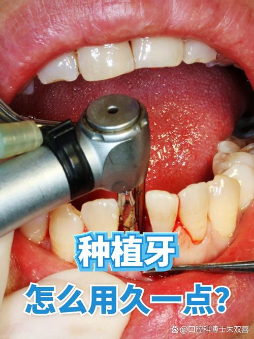 牙周病的人可以植牙吗-图1