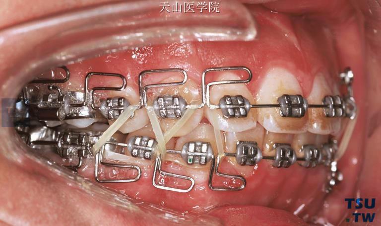 正畸meaw弓弯制的技巧与难点有哪些？-图2