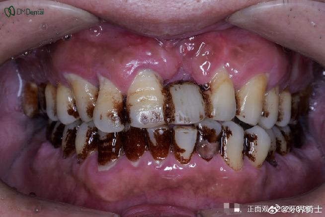 种植牙植骨粉失败会有哪些表现？-图1