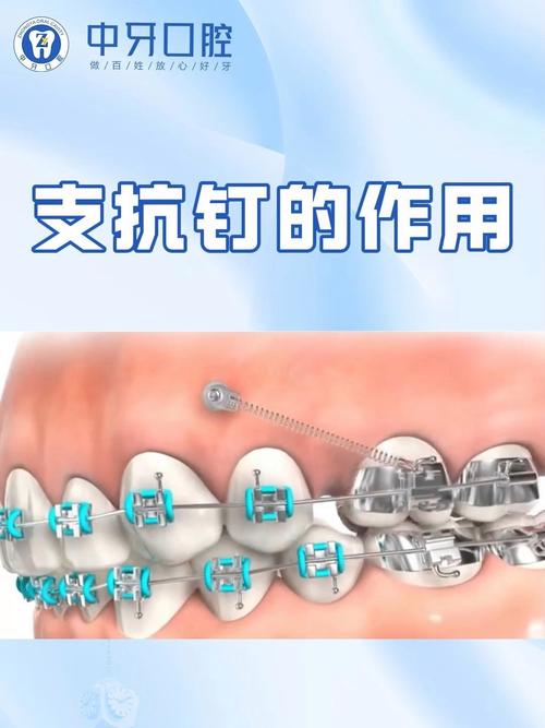 正畸种植支抗钉型号-图1