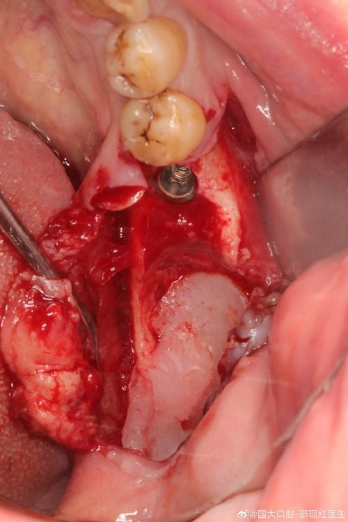 牙槽植骨后植骨区疼痛-图2