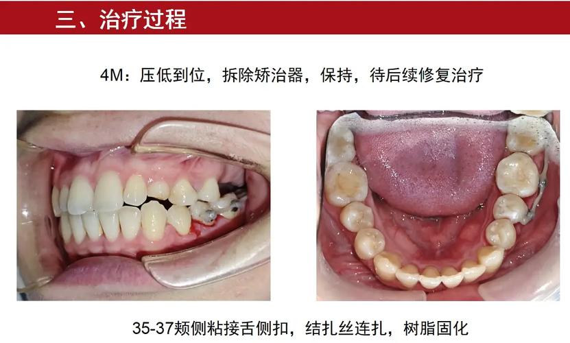 正畸支抗失控会有哪些具体表现?-图2 正畸支抗失控会有哪些具体表现?-图2