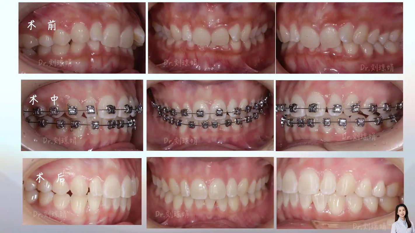 正畸支抗失控会有哪些具体表现?-图3 正畸支抗失控会有哪些具体表现?-图3