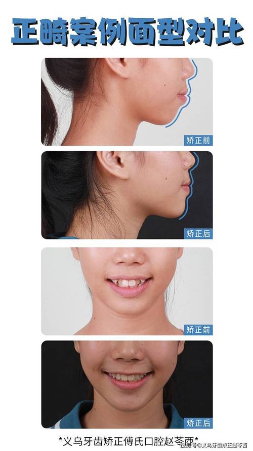 牙齿正畸能矫正侧牙不齐吗？-图1