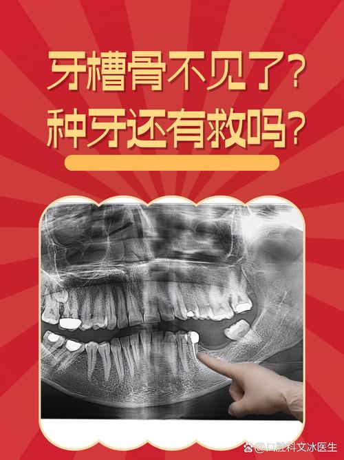 牙槽骨缺失还能植牙吗-图2