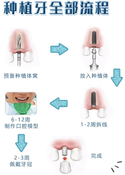 正畸种植钉植入方法的关键步骤有哪些？-图2