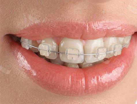 关于半透明陶瓷正畸-图1