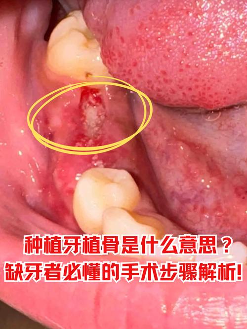 植牙可以植在颧骨上吗-图1